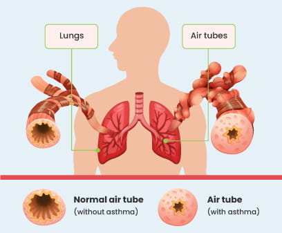 Asthma